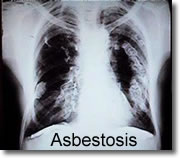 Asbestosis X-ray