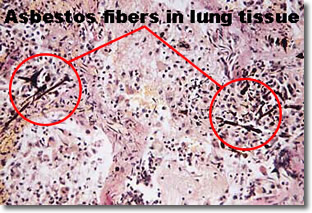 Asbestos fibers in tissue