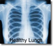 Normal Lung X-ray