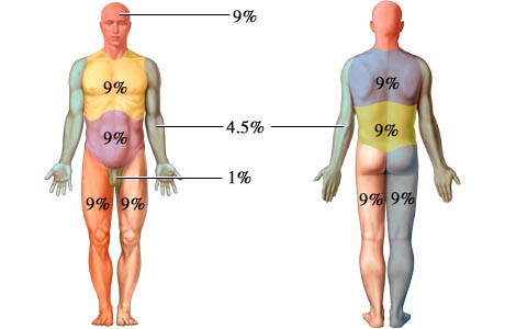 Burn Percentage Chart Rule Of 9