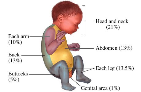 Rule of Nine for Infant:
Head and Neck 21%
Each Arm 10%
Abdomen 13%
Each Leg 13.5%
Genital Area 1%
Back 13%
Buttocks 5%