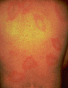 multiple rashes occur as a reaction when the bacteria moves through the body: MDH