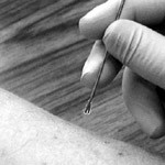 Photo showing gloved hand administering smallpox with a bifurcated needle. 