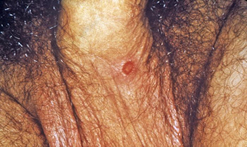 image of chancre on penis
