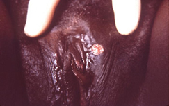 image of chancre on genitals