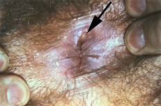 image of chancre on genitals