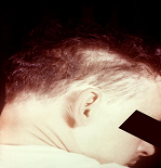 image of alopecia