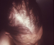 image of alopecia