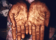 image of rash