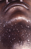 image of rash