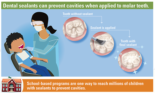 A dental hygienist applies a dental sealant to the molar of a child.